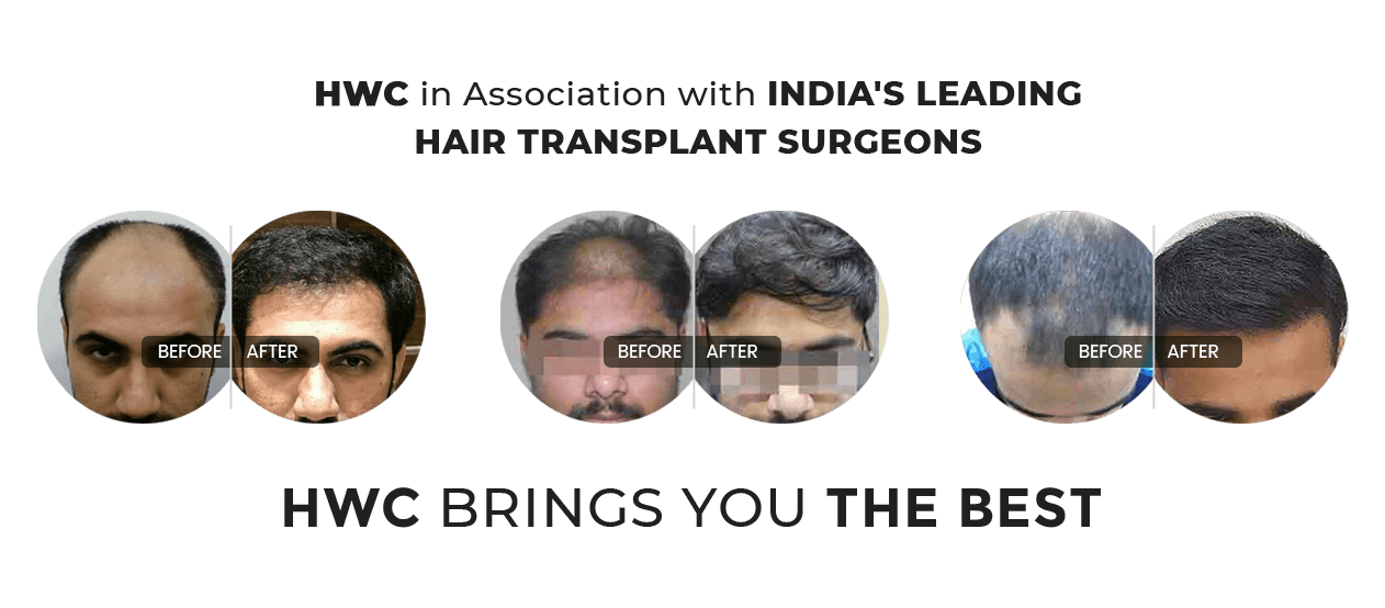 Fue Hair transplant specialist in kochi Calicut  kerala Hair Wellness Clinic