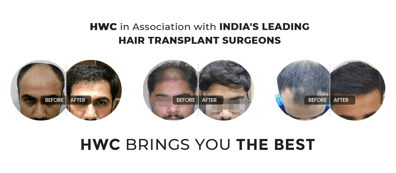 Best Fue Hair Transplant hair fixing in Kerala Kochi Calicut HWC