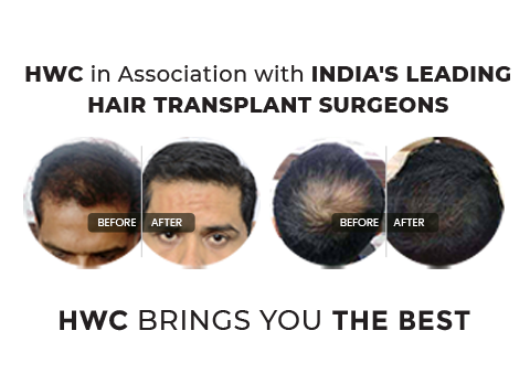Non surgical hair replacement specialist in kochi Calicut kerala Hair Wellness Clinic