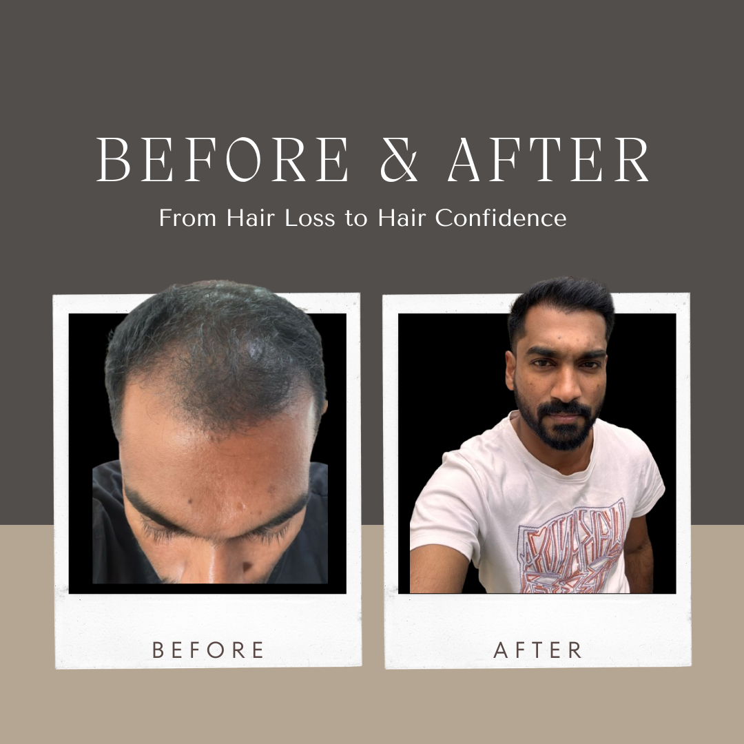 Why Hair Transplants Are a Lifetime
                                Investment
