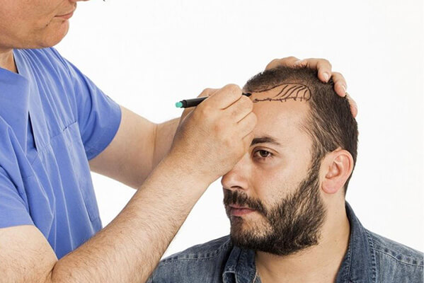 Best Fue Hair Transplant | hair fixing in Kerala Kochi Calicut | HWC Best Fue Hair Transplant | hair fixing in Kerala Kochi Calicut | HWC