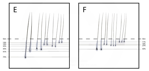 Severity Of Hair Loss HWC