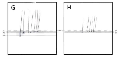 Severity Of Hair Loss HWC