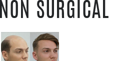 Non surgical Hair replacement in kochi calicut Hair Wellness Clinic