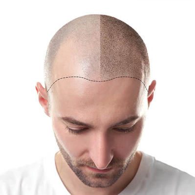 Scalp Micro Pigmentation hair treatment in Hair Wellness Clinic