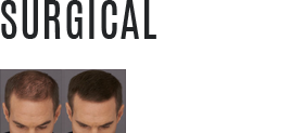 Surgical hair transplantation in kerala Hair Wellness Clinic