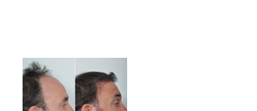 Surgical hair restoration in kerala Hair Wellness Clinic