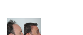  Best hair restoration clinic in Kerala - Hair Wellness Clinic
